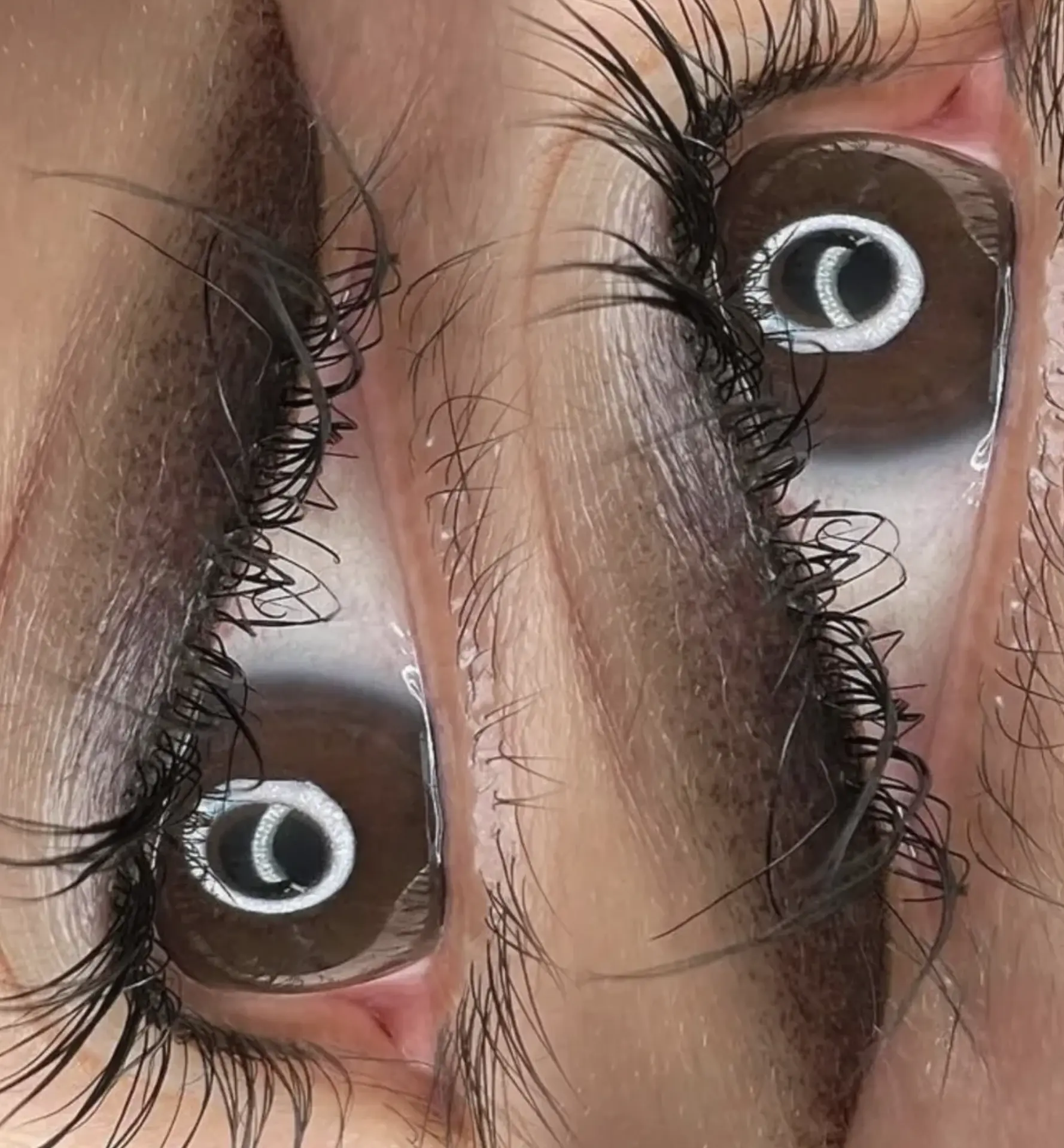 eyeliner tattoo removal