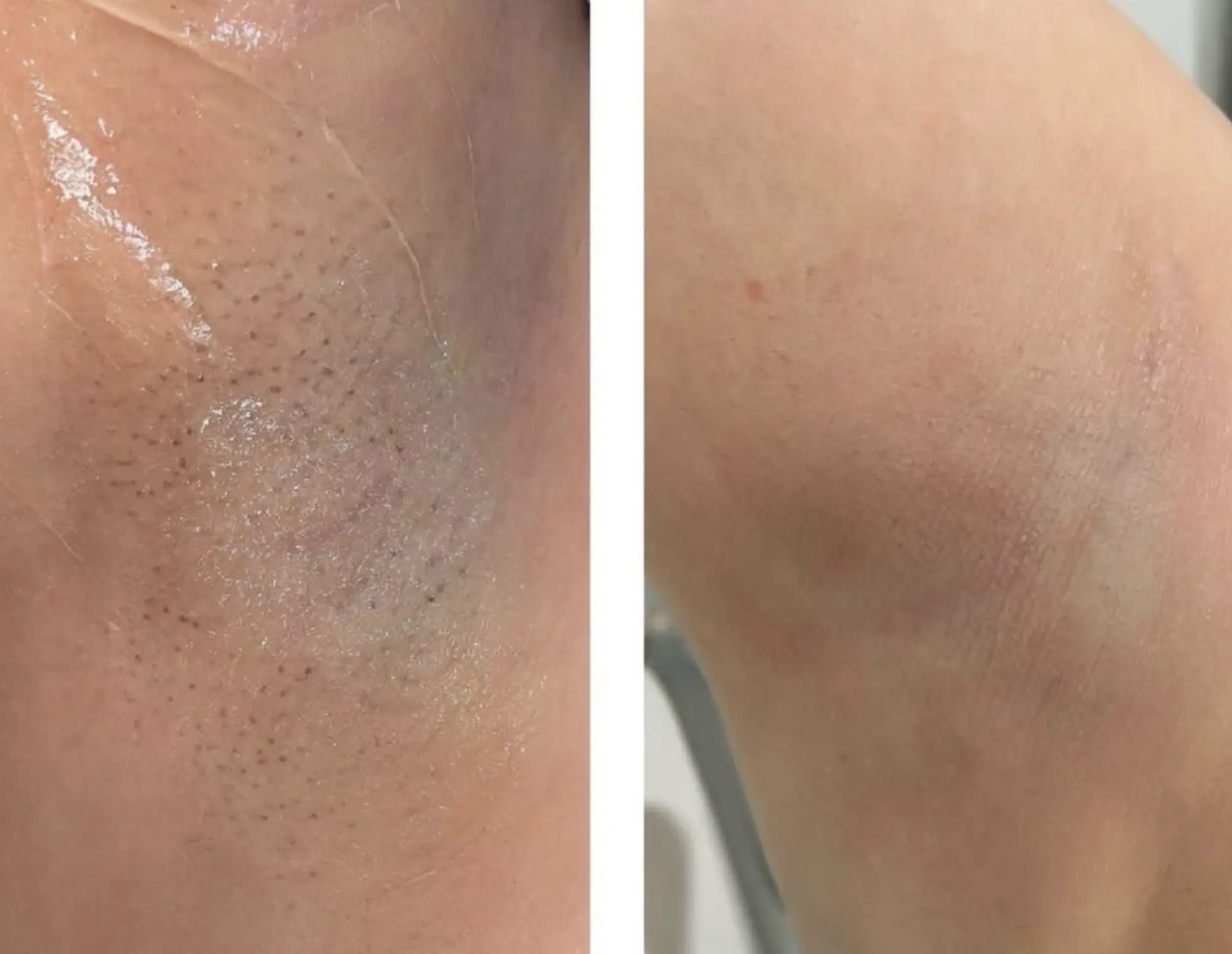 laser hair removal course